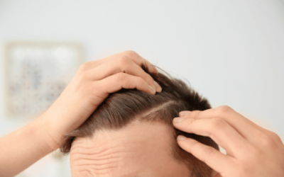 Can Adderall Cause Hair Thinning?